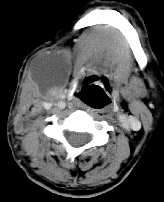 tonsil Palatal