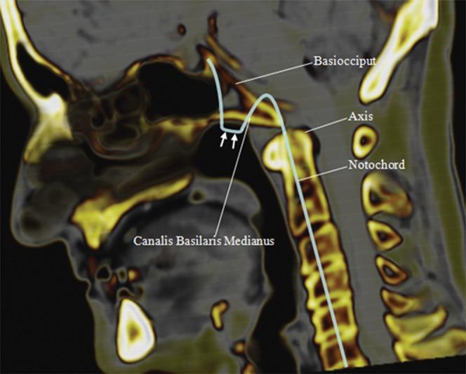 Lohman BD, Sarıkaya B, Mckinney AM, Hadi M. Not the typical Tornwaldt's cyst this time?