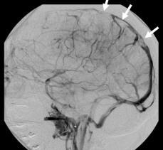 Serebral anjiografi Altın Standart Diğer tekniklerle sonuca