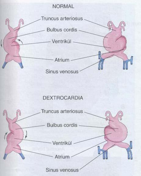 2.2. Kalbin Konjenital Anomalileri 2.2.1. Dextrocardia Kalbin sağa doğru yer değiştirmesidir. Eğer kalp tüpü sağa yerine sola doğru eğim yaparsa kalp sağa doğru yer değiştirir.