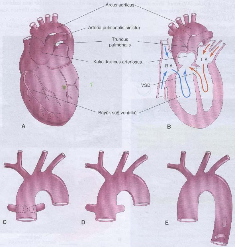 2.2.5. Truncus Arteriosus Kalpten çıkan tek bir ana arteriel damar vardır ve sistemik, pulmoner ve koroner dolaşımları besler. VSD truncus arteriozusla birliktedir (Snell 2004).