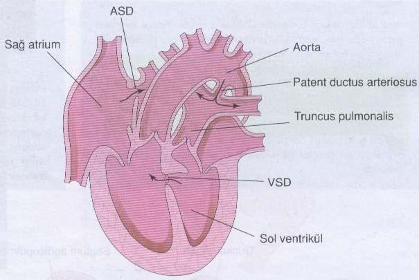 2.2.6. Büyük Arterlerin Transpozisyonu Yeni doğan bebeklerde siyanotik kalp hastalıklarının en sık nedenidir. Aorta sağ ventrikülden, truncus pulmonalis sol ventrikülden çıkar (Şekil 17).