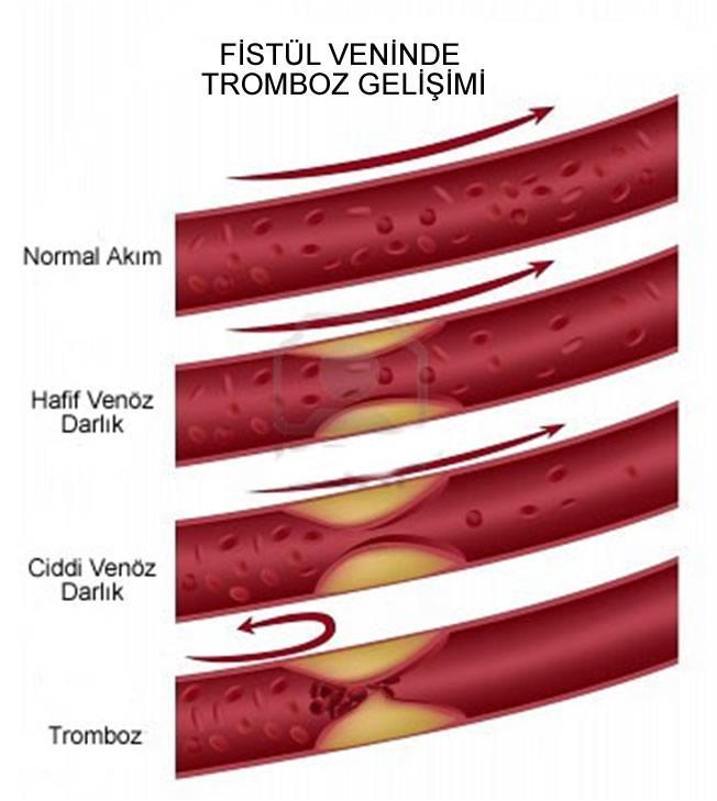 Venöz Stenoz Varlığını, Yerini ve Derecesini Belirleyin Arteriyalize vende nabız alınması, venöz stenozun göstergesidir.