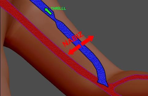 Nabız nedir? Anastomozdan geçen kan akımına, venöz sistemin gösterdiği dirençtir. İdeal bir fistülde nabız hissedilmemelidir.