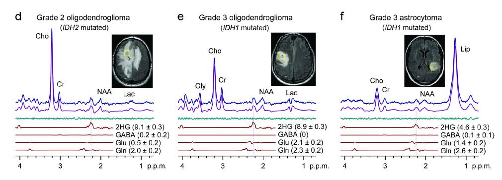 D2 Hidroksi glutarat, 2.