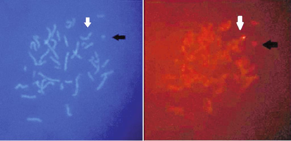 RESİM 2: Hastaya ait karyotip görüntüleri (46,X,ring(Y)/45,X) (Giemsa boya kullanılmıştır). RESİM 3: Hastanın SHOX genine ait FISH analiz görüntüsü.