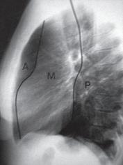4 2. GENEL BİLGİLER 2.1. Mediasten 2.1.1. Anatomisi Mediasten veya mediastinum, kalp ve akciğer dışında kalan torakal viserayı kapsayan, plevral boşluklar arasında kalan anatomik alan olarak tanımlanır.