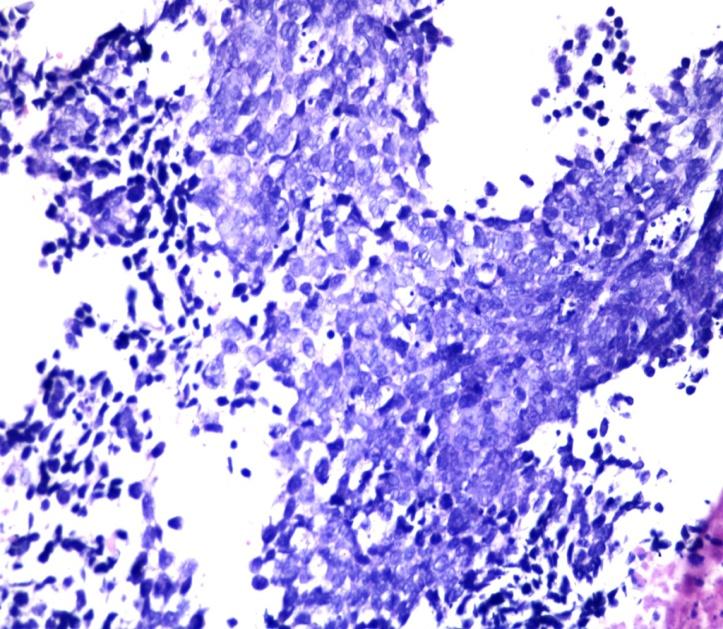 paratrakeal, hiler ve aortikopulmoner lokalizasyonda multiple LAP tespit edilen 2 hasta, hastanemiz endosonografi ünitesine mediastinal lenf nodu biyopsisi için gönderilmiş.