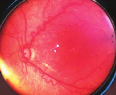 Ridge evresidir. Yani retina yüzeyinin üstüne doğru çıkan ve vitreusa invaze olmayan yapıdır. Beyaz veya gri olabilir, bu hattın gerisinde POPCORN denilen küçük vasküler anomaliler olabilir.