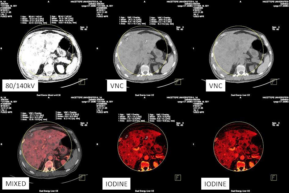 Resim 4.9. 14 no lu hastada karaciğerde yaygın metastazlar izleniyor.