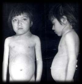 Hodgkin's disease in Turkish children: A