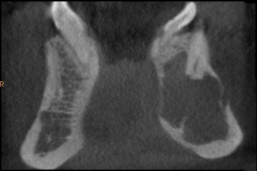 Bu vaka raporunda mandibulada kök rezorbsiyonuyla birlikte izlenen santral odontojenik fibromanın klinik bulguları, konik ışınlı bilgisayarlı tomografi ile 3 boyutlu radyolojik incelemesi, tedavi