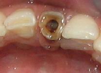 50 ALİYE KAMALAK-ALİ KELEŞ laştırılarak dişlerin yeniden kazanılması sağlanabilir, ancak cisim daha apikale itilmiş ise tedavi daha komplike olabilir.