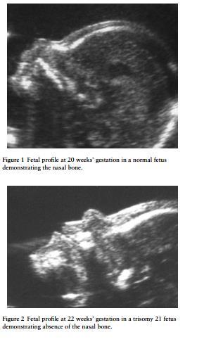 Nazal Kemik 15-22 haftalar arası Fetal yüzün mid-sagital kesiti İnsonasyon açısı 45e-135 e yakın olmalı Aplazi veya 2.