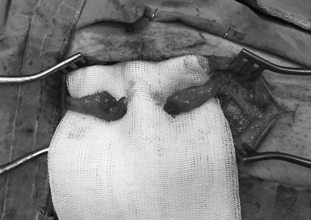 Y. Akyuva, M. Kahraman, E. Civelek, S. Kabataş yapıldı. Sağ diz lateralinde eski insizyon hattı distalden ve proksimalden genişletildi.