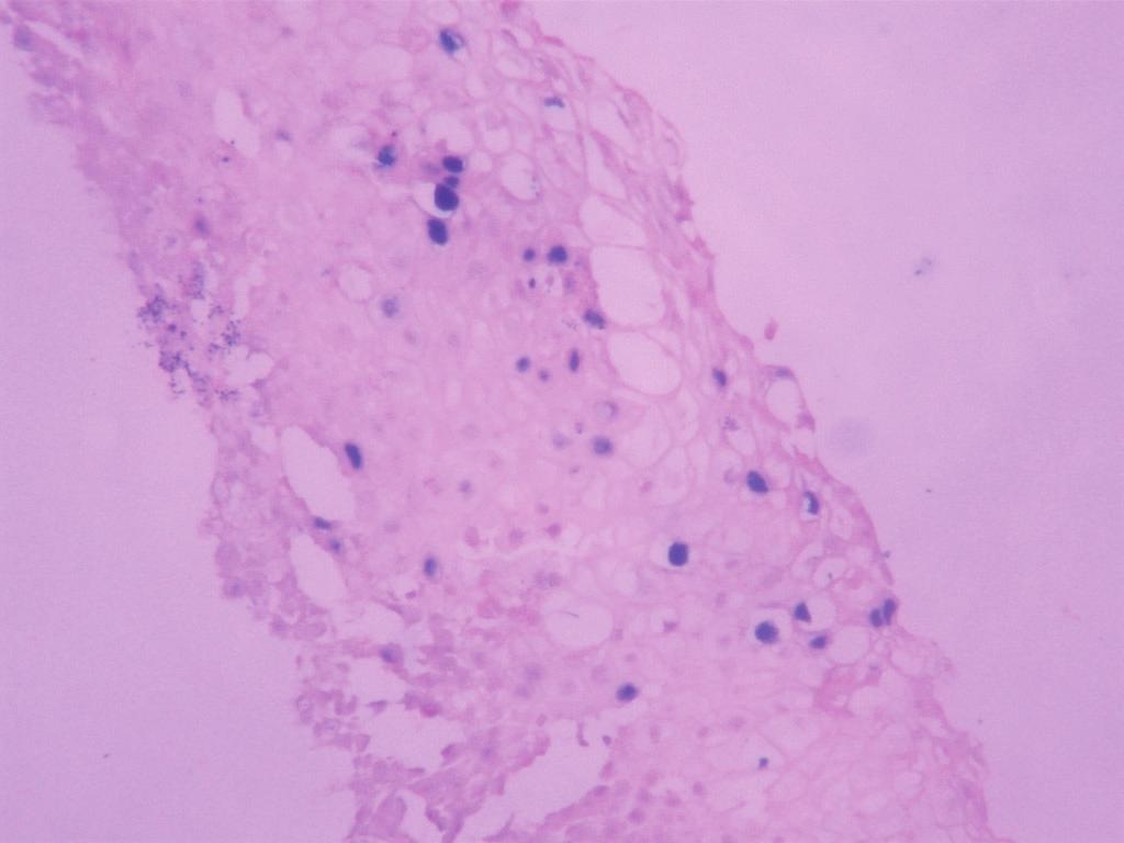 ureaplasma și condiloamele în signs and symptoms of papillomas