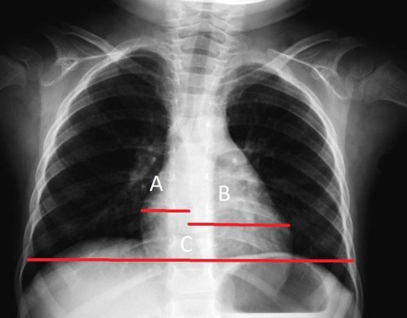Pediatrik Akciğer Grafisi Pediatric Chest Radiography 34 Şekil