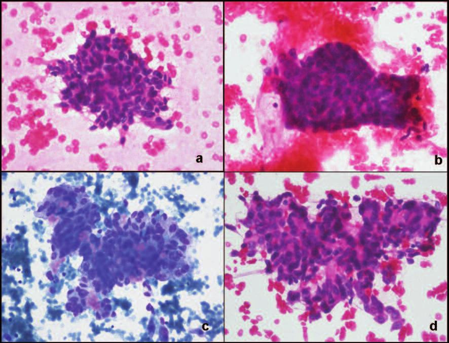 Medical Pathology berraklaşmanın yanı sıra, iğsi hücreler ve skuamotoid (morular) alanların varlığı diğer ilgi çekici özelliklerindendir.