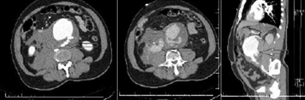 160 Damar Cer Derg (a) (b) (c) Şekil 1. Ameliyat öncesi bilgisayarlı tomografi görüntüleri.