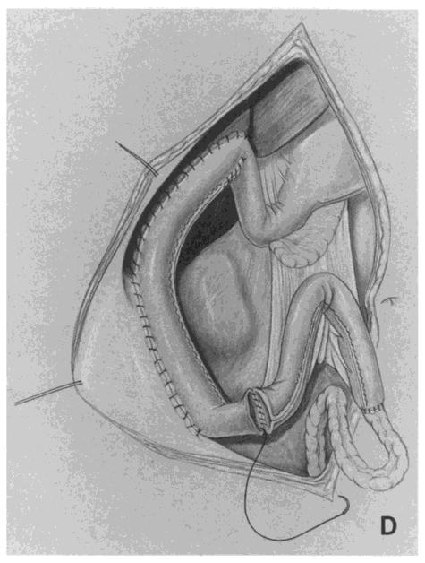 bowel elongation technique for the