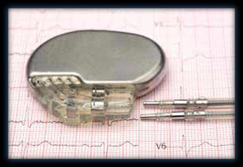 Cihaz özellikleri Batarya ve elektronik devre Uyarı(pulse) jenaratörü Algılayan (sensing)