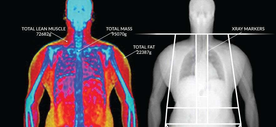 Dual enerji X-ray absorbsiyometri Vücut dokularının farklı