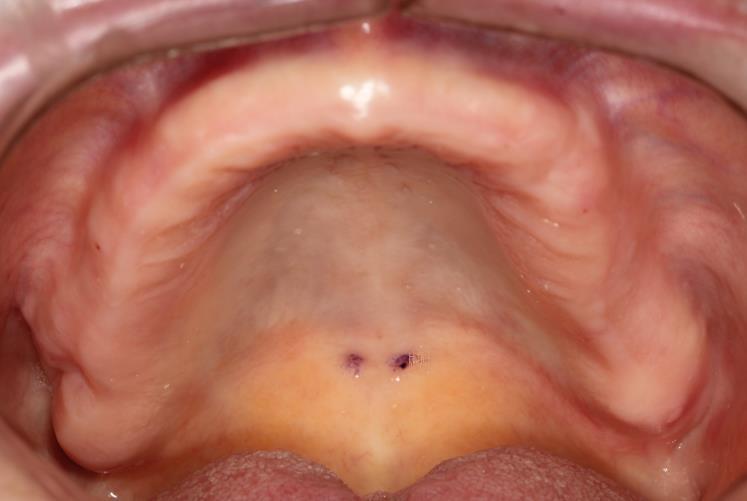 51 Şekil 3.3.1. Üst tam dişsiz bireyin ağız içi görüntüsü. Ağız içi ölçümlerde ise öncelikle anterior titreşim hattı, posterior titreşim hattı ve fovea palatinaların yerleri belirlenmiştir.