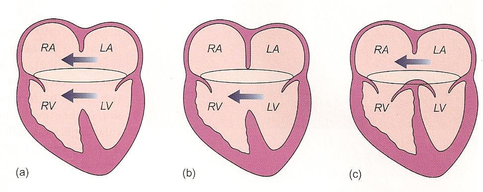 Atriyoventriküler Septal Defekt AVSD Endokardiyal