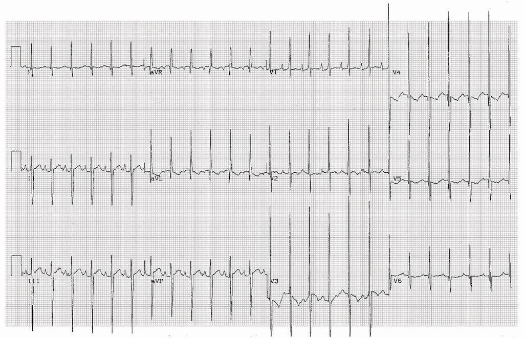 AVSD Tele: Kalp büyük Pulmoner konus belirgin Akciğer kanlanması artmış EKG: Sol aks sapması