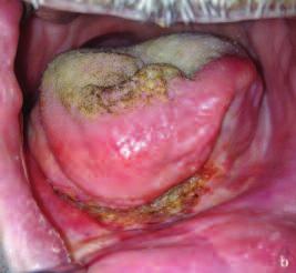 Kesi sırasında lazerin ucu, dil ile ağız tabanı arasında mevcut olan skar dokusu boyunca hareket ettirildi.