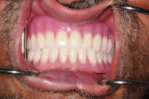 dental implantlar ile yumuşak doku rekonstrüksiyonuna ihtiyaç duyulmaktadır.