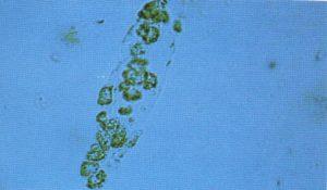Sellüler Silendirler Sellüler silendirler idrar sedimentinde görülebilen eritrosit, lökosit, renal tübüler epitel hücreleri gibi bütün hücrelerden oluşabilir.