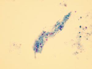 Renal tübüler nekrozda, CNV nefriti gibi viral hastalıklarda böbrek nakli sonrası doku rejeksiyonu sırasında idrarda sık görülür.