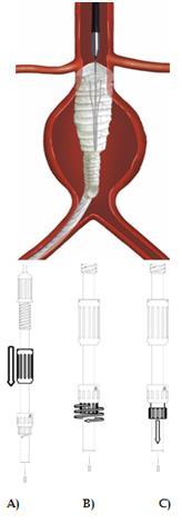 Ana gövdenin aortik kısmının yerleştirilmesi İpsilateral bacağın yerleştirilmesi Greftin aortik kısmını yerleştirin: A) Kılıf kumandasını yuva salınana kadar