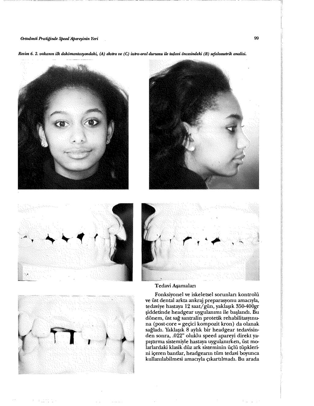Ortodonti Pratiğinde Speed Apereyinİn Yeri 99 Resim 6. 2. vakanın ilk dokümantasyondaki, (A) ekstra ve (C) intra-oral durumu İle tedavi öncesindeki (B) sefalometrik analizi.,,1.