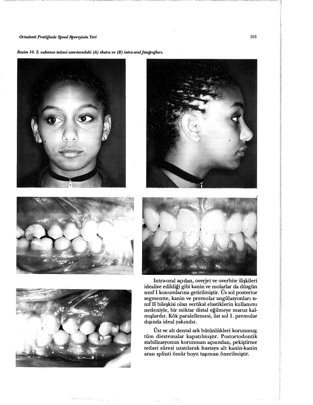 Ortodonti Pratiğinde Speed Apereyinin Yeri 101 Resim 10. 2, vakanın tedavi sonrasındaki (A) ekstra ve (B) intra-oral fotoğrafları.