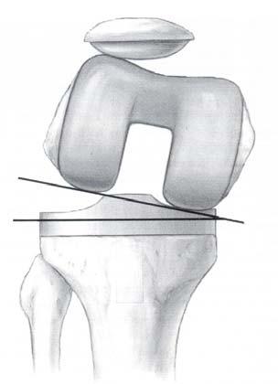 Bu da patellayı laterale subluksasyona predispozan hale getirir. Benzer mekanizmayla tibial komponentin mediale yerleştirilmesi de patellar instabiliteye yol açar.