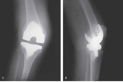 Tip II: Komponent gevşemesi yada malpozisyonu ile beraber redükte edilebilir ve yeterli distal kemiğin olduğu kırık. Bu kırıklar uzun stemli revizyon komponent ile tedavi edilir.