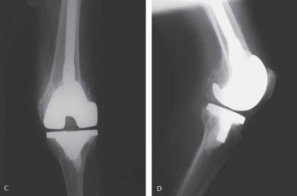 (176) Tip III: Komponenti destekleyecek yeteli kemik yoktur ve parçalı kırık vardır. Bu kırıklarda en iyi tedavi distal femoral prostetik replasmandır.