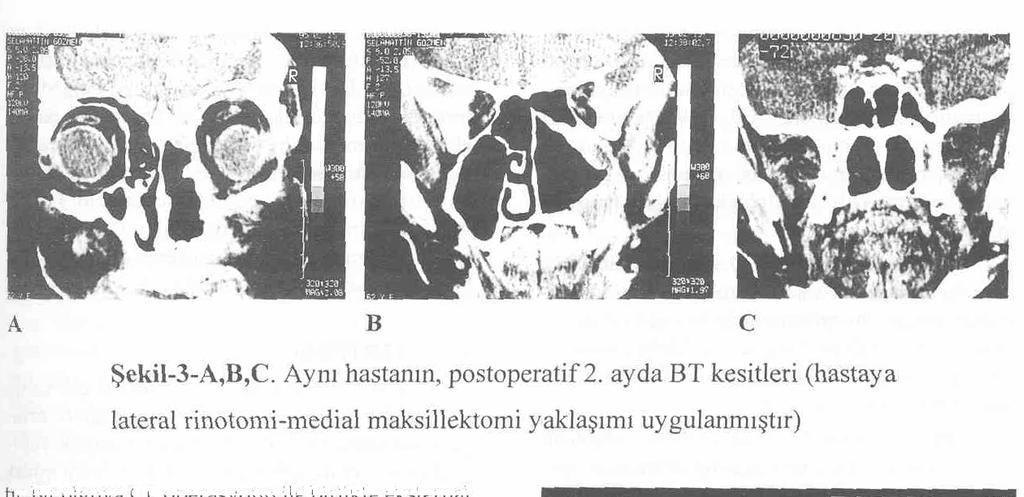 .K.B.B. ve Baş Boyun Cerrahisi Dergisi, 1998; 6 (3): 139-146 tır.