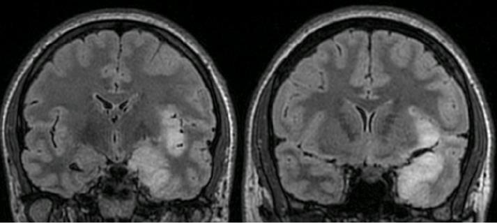 Herpes Simplex Virus Ensefaliti Görüntülemede en sık temporal lob tutulumu vardır EEG de tutulumu