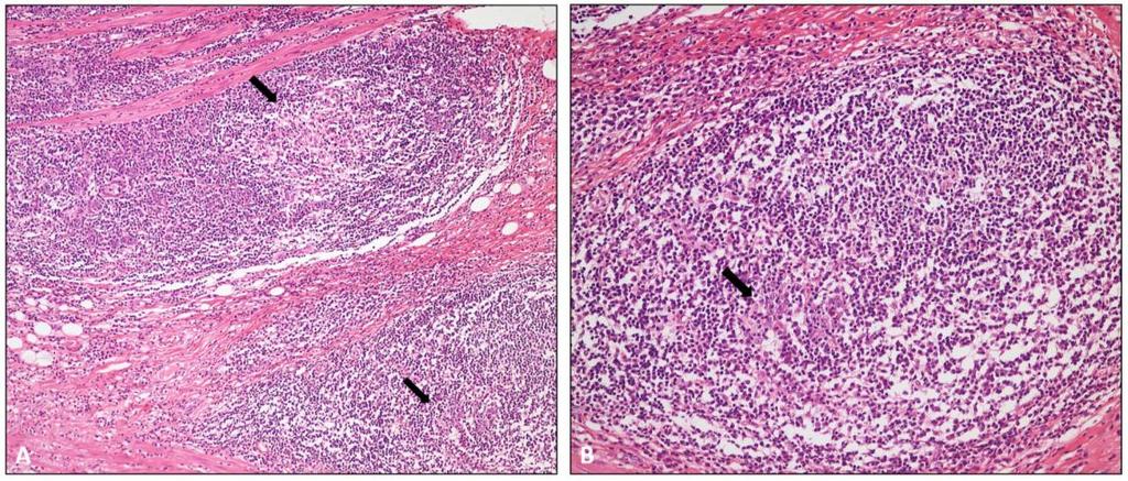 hücre adaları; x200x; (B) Neoplastik hücre adalarının yakından görünümü, yer yer TIL ler dikkati çekiyor; x400 Resim 4.5.