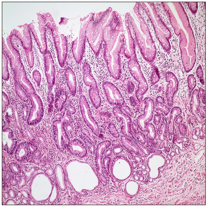 oluşan tümör x100; nekroz içerisinde inflamatuar hücreler dikkat çekiyor (iç resim); x400, (B) Kas demetlerini infiltre