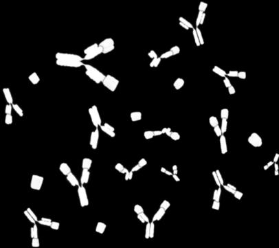 Osteoblastlar Osteoklast Tümör Denosumab, osteoklastların