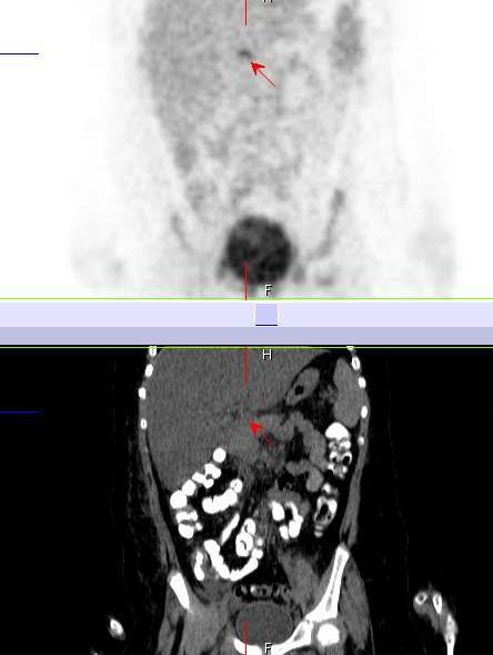 inguinal multiple