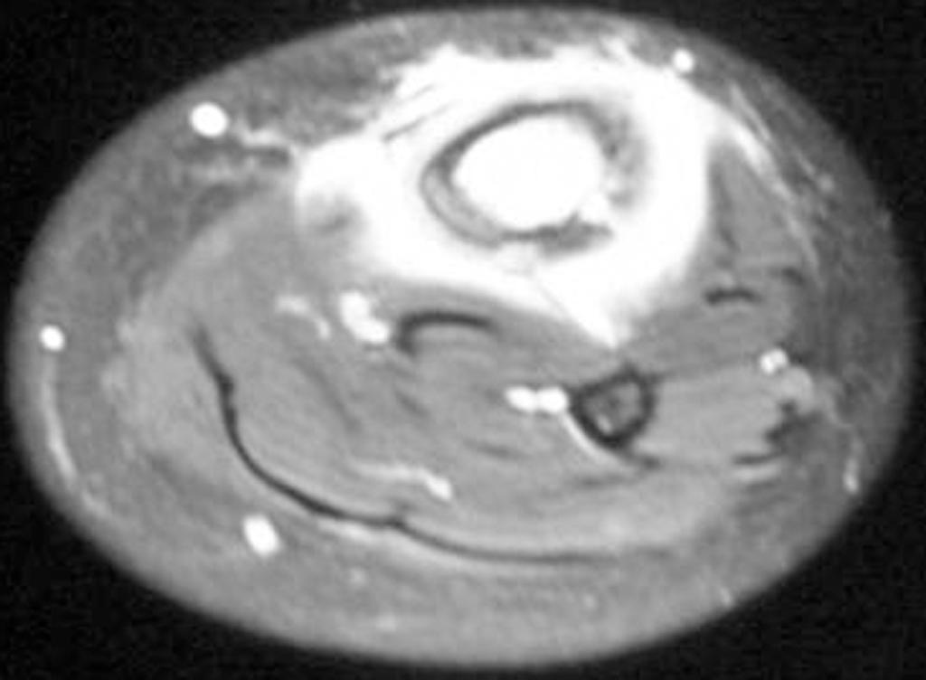 MR görüntülemedeki bu abartılı tablo, lezyonun yanlışlıkla habis bir tümör olarak değerlendirilmesine yol açabilir.