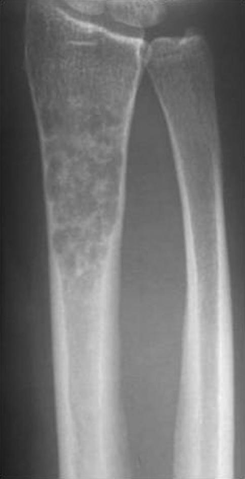 Radyoizotop kemik sintigrafisi, BT ve MR görüntüleme, konvansiyonel radyografilerin normal göründüğü hastalarda kemik lezyonlarını erken dönemde gösterebilir.