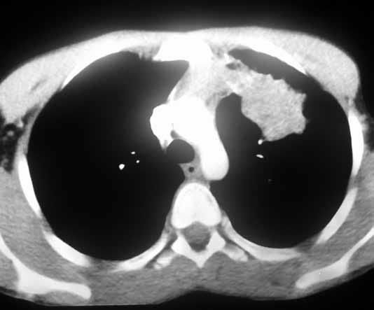 Akciğer kanseri (3 hasta)