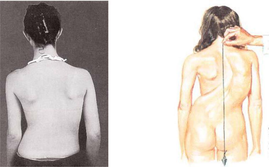 omuzları ve her iki iliak kanatları görülecek şekilde, tercihen çıplak yapılmalıdır(4). İnspeksiyonda hastanın genel durumu, postürü incelenir.