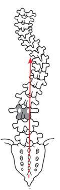 Santral sakral dikey çizgi, stabil vertebraya kadar lomber vertebraların pedikülleri arasında ilerliyorsa, lomber belirleyici tip A olarak değerlendirilir.
